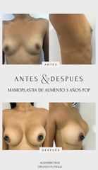 Mamoplastia de aumento - Dr. Alejandro Ruiz Cortés