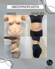 Abdominoplastia - Dr. Alejandro Ruiz Cortés