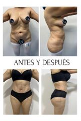 Liposucción - Dr. Alejandro Ruiz Cortés