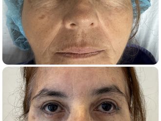 Blefaroplastia antes y después - 875429