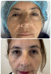 Blefaroplastia - Dr. Jaime Eduardo Vallejo Flórez