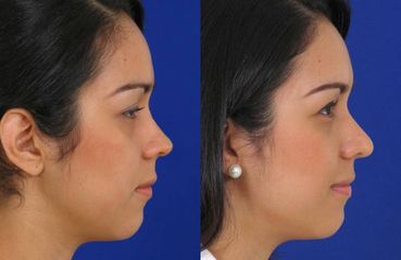 Rinoplastia en Colombia