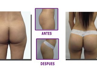 Aumento de Gluteos