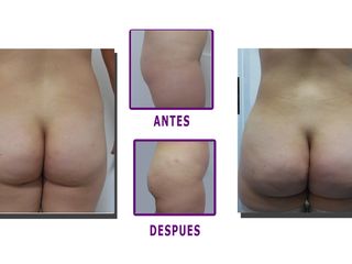 Aumento de Gluteos