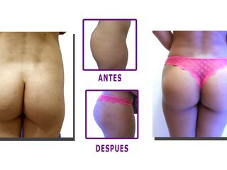 Aumento de Gluteos