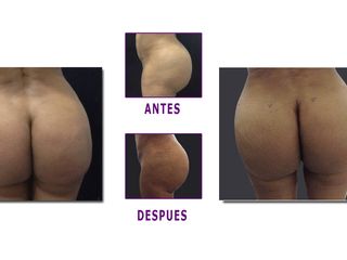 Antes y despues de aumento de gluteos