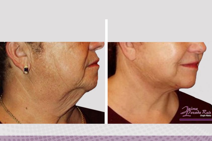 Mentoplastia antes y después - 642458