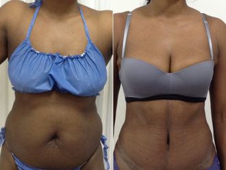 Abdominoplastia antes y después - 873064