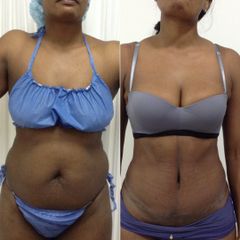 Abdominoplastia