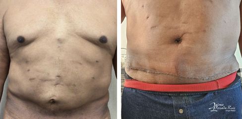 Abdominoplastia - Dr. Jaime Lozada Ruiz