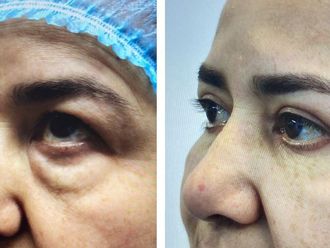 Blefaroplastia antes y después - 873069