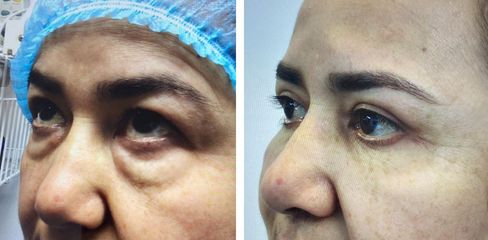 Blefaroplastia -Dr. Jaime Lozada Ruiz