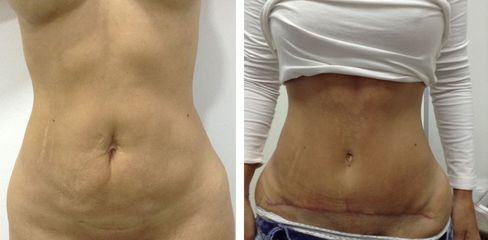 Abdominoplastia -Dr. Jaime Lozada Ruiz