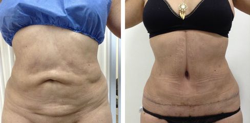 Abdominoplastia - Dr. Jaime Lozada Ruiz