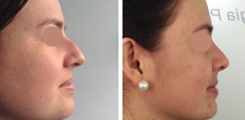 Rinoplastia - Dr. Jaime Lozada Ruiz