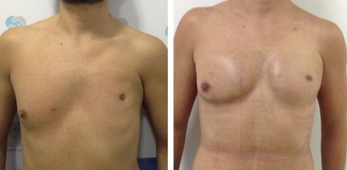 Implante Pectoral - Dr. Jaime Lozada Ruiz