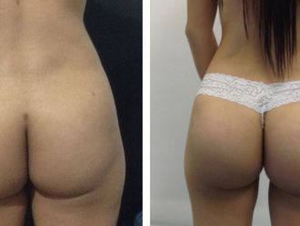 Gluteoplastia antes y después - 873074