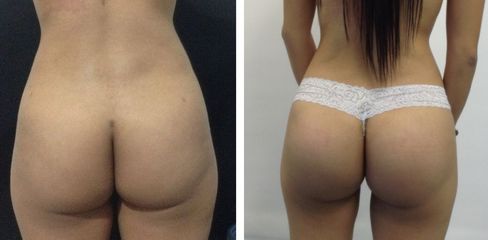 Gluteos - Dr. Jaime Lozada Ruiz