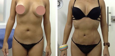 Liposucción -Dr. Jaime Lozada Ruiz