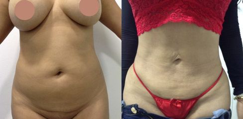 Liposucción - Dr. Jaime Lozada Ruiz