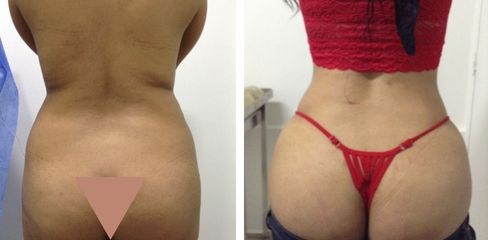 Liposucción - Dr. Jaime Lozada Ruiz