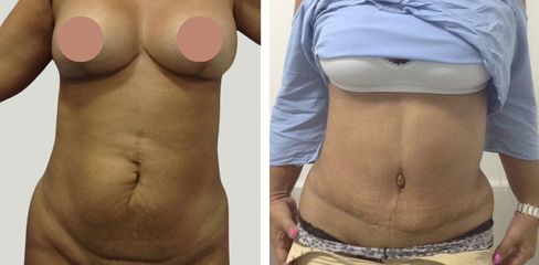 Abdominoplastia - Dr. Jaime Lozada Ruiz