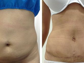 Abdominoplastia antes y después - 873175