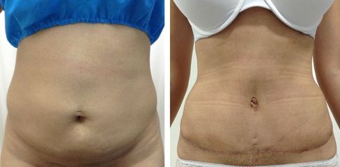 Abdominoplastia -Dr. Jaime Lozada Ruiz