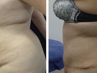 Abdominoplastia antes y después - 873176