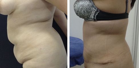 Abdominoplasta -Dr. Jaime Lozada Ruiz