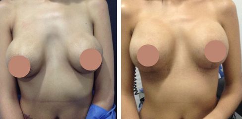 Cambio de Implantes -Dr. Jaime Lozada Ruiz