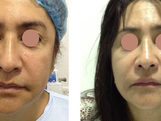 Rejuvenecimiento facial antes y después - 873917