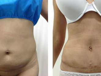 Abdominoplastia antes y después - 873919