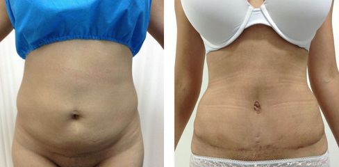 Abdominoplastia -Dr. Jaime Lozada Ruiz