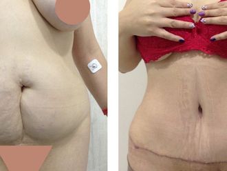 Abdominoplastia antes y después - 873951