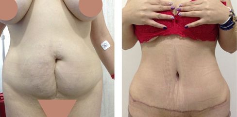 Abdominoplastia - Dr. Jaime Lozada Ruiz