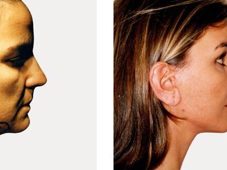 Rejuvenecimiento facial antes y después - 874011