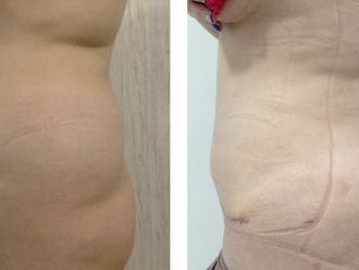 Abdominoplastia antes y después - 874012