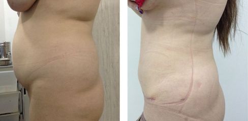 Abdominoplastia - Dr. Jaime Lozada Ruiz