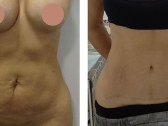 Abdominoplastia antes y después - 874013