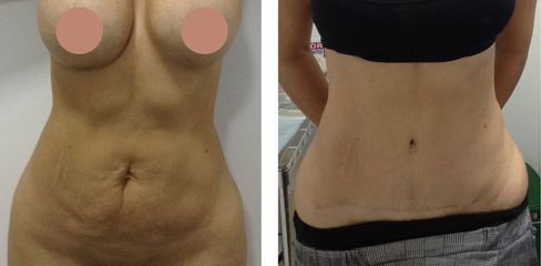 Abdominoplastia - Dr. Jaime Lozada Ruiz