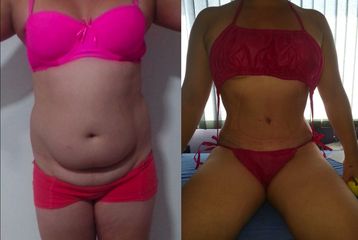 Dr. Fernando Andrés Cabrera - Abdominoplastia