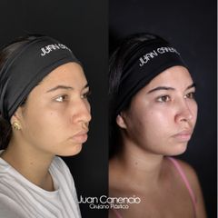 Rinoplastia - Dr. Juan Canencio