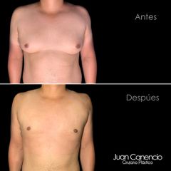 Resección de ginecomastia - Dr. Juan Canencio