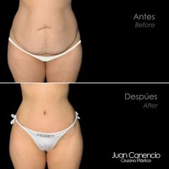 Abdominoplastia+ Lipoescultura - Dr. Juan Canencio