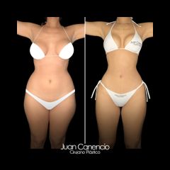 Lipoescultura - Dr. Juan Canencio