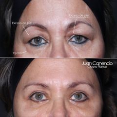 Blefaroplastia - Dr. Juan Canencio