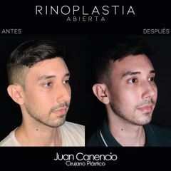 Rinoplastía - Dr. Juan Canencio