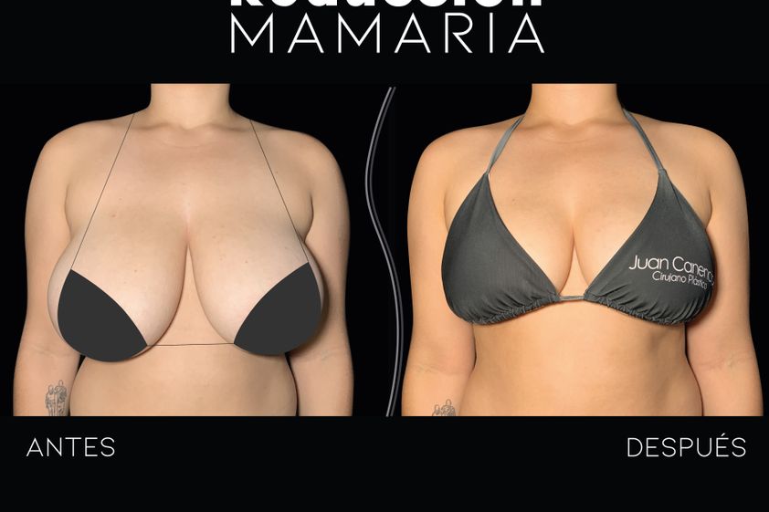 Mamoplastia de reducción antes y después - 868706