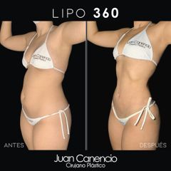 lipo 360 -katalina diseño copia